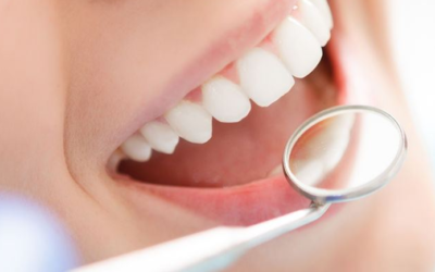 Carie dentale: cosa è, come prevenirla e come curarla.